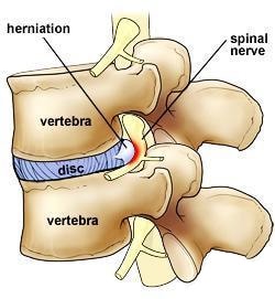 Back Disc Prolapse