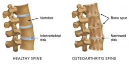 Back Degenerative Disc Disease