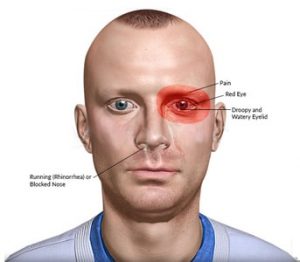 Headache Cluster