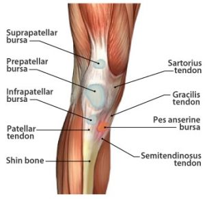 Knee Bursitis