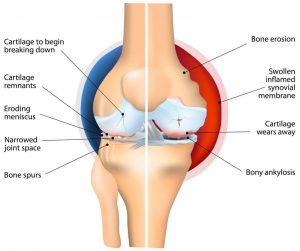 Knee Rheumatoid Arthritis
