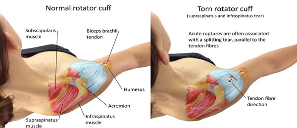 Shoulder Rotator Cuff Tear